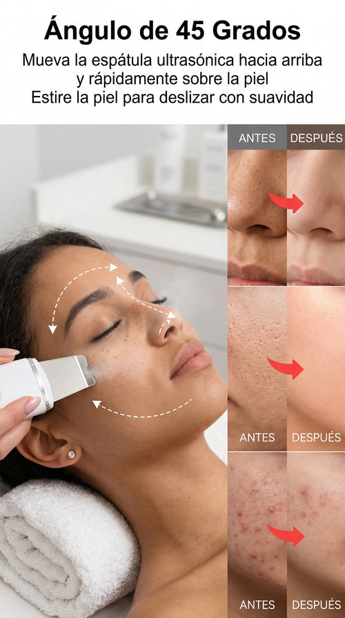 Removedor Ultrasónico de Puntos Negros – Limpieza Facial Profunda